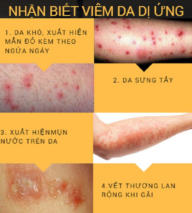 Cách dùng thuốc điều trị viêm da dị ứng