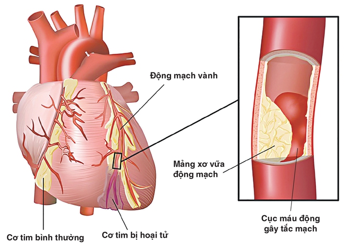 Bệnh động mạch vành