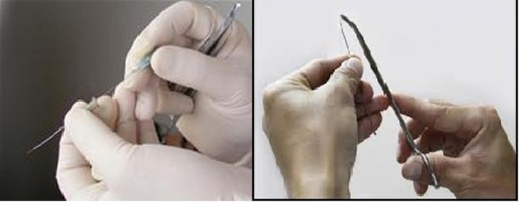 Cấy chỉ và những lưu ý khi điều trị