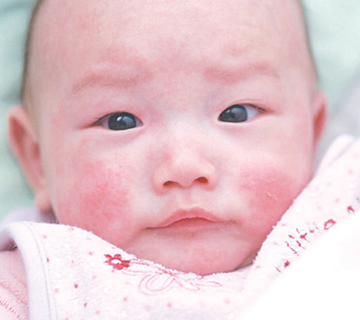 Nếu con bị chàm sữa, mẹ “cai” những gì?