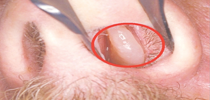 Chẩn đoán và điều trị polyp mũi