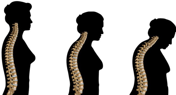 Bệnh loãng xương điều trị đúng mới có hiệu quả