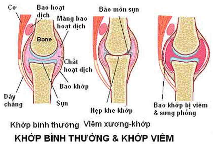 Cách phát hiện sớm bệnh viêm khớp