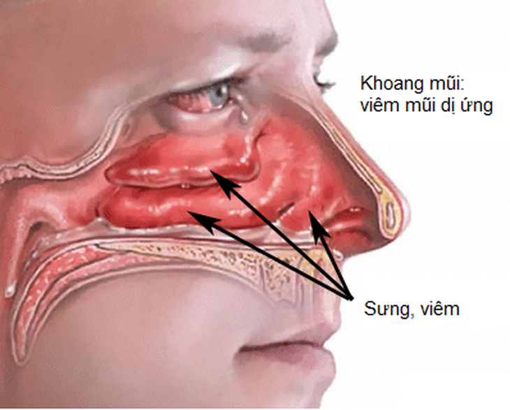 Sử dụng thuốc xịt mũi dài ngày có gây hại?