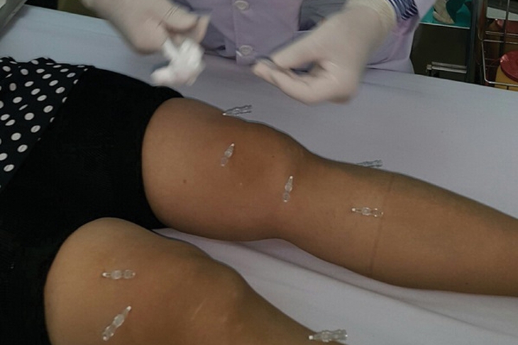 Cấy chỉ và  những ứng dụng