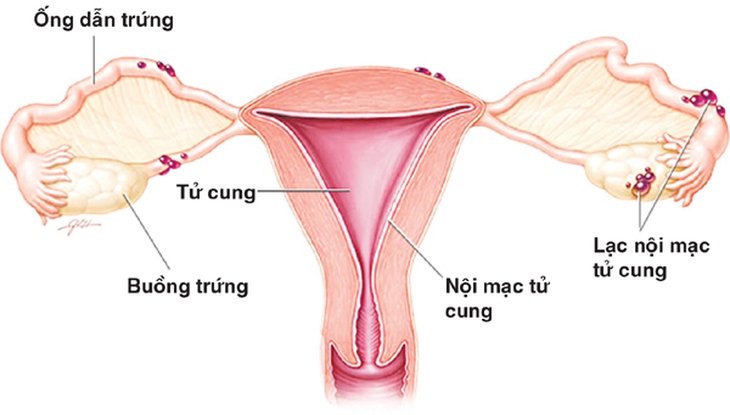 Lạc nội mạc tử cung