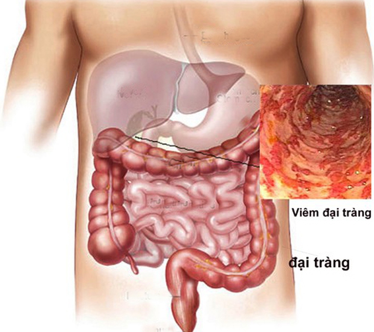 Bệnh viêm loét đại tràng