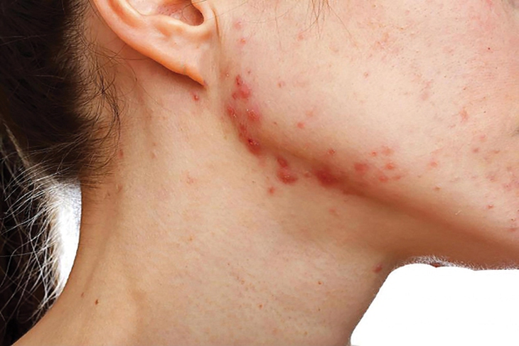 Lạm dụng thuốc trị mụn trứng cá isotretinoin đường uống có thể bị thuyên tắc mạch, sa sút trí tuệ
