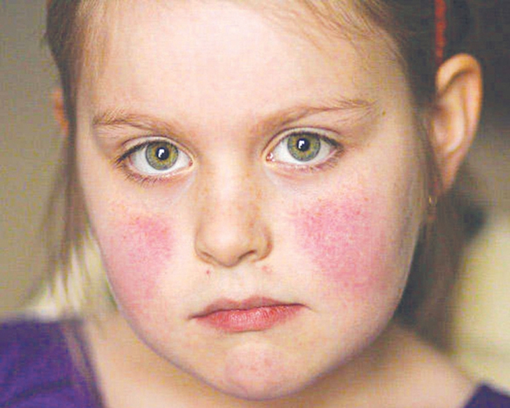 Xét nghiệm kháng nguyên HLA-DR2 giúp chẩn đoán lupus ban đỏ hệ thống