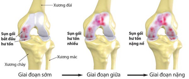 Điều trị thoái hóa khớp gối
