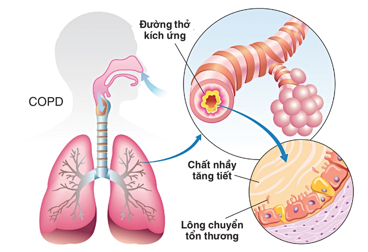 Chất nhầy ở bệnh nhân COPD có thể dẫn đến nghẹt thở khi ngủ.