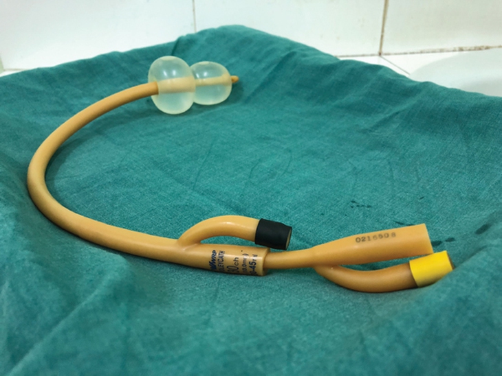 Kỹ thuật bóng đôi giúp hạn chế sinh mổ