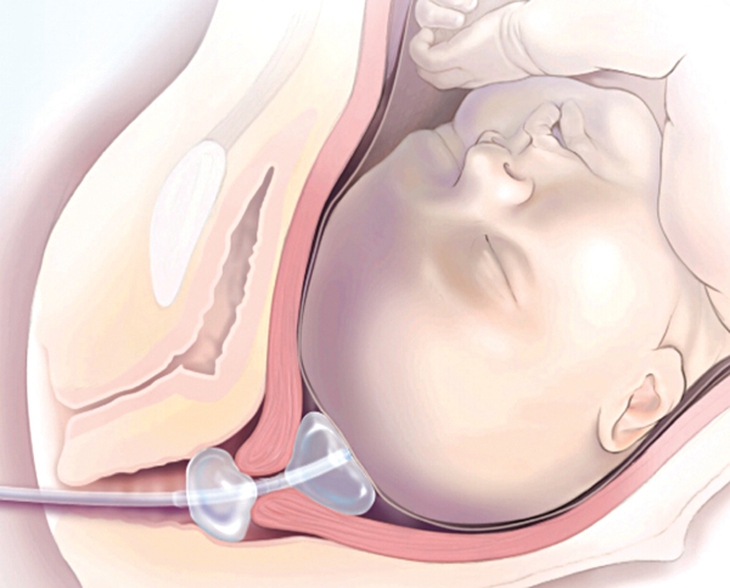 Kỹ thuật bóng đôi giúp hạn chế sinh mổ