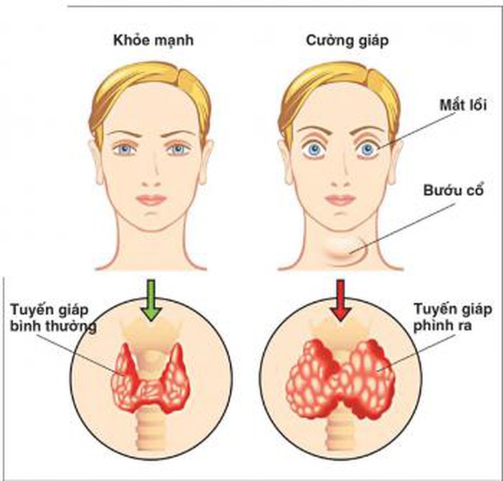 Những hệ lụy do thiếu i-ốt gây ra.
