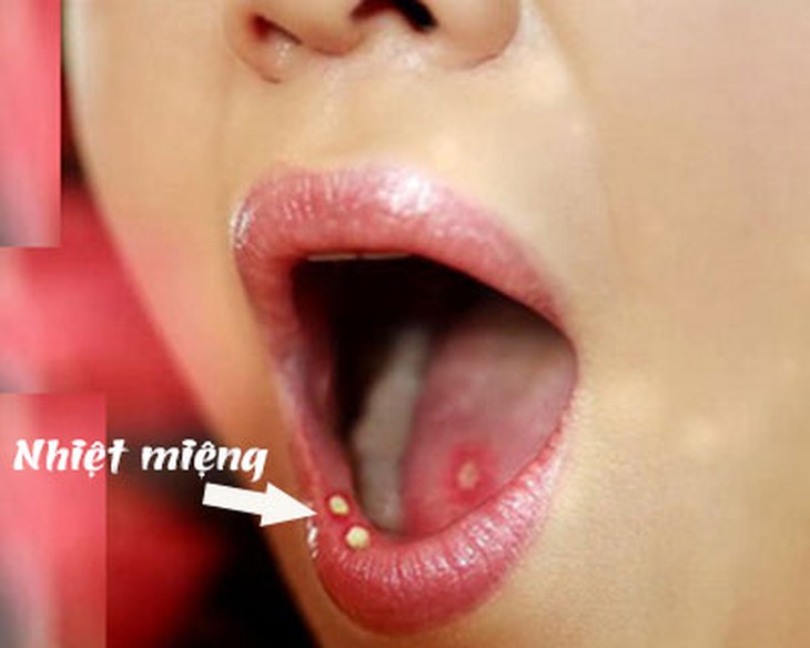 Chọn thuốc trị loét miệng áp-tơ