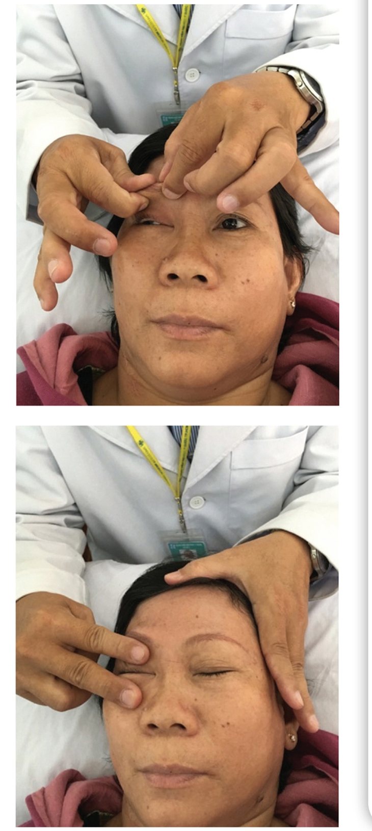 Điều trị sụp mi mắt sau phẫu thuật