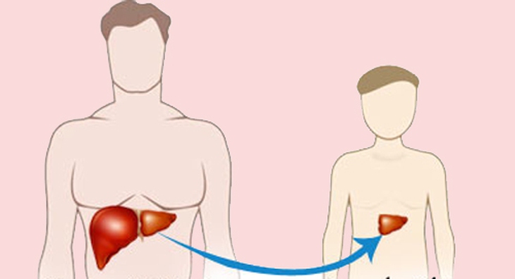 Ghép gan điều trị ung thư