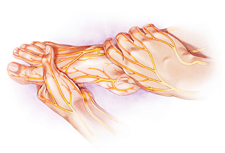 Bệnh thần kinh  ngoại biên do đái tháo đường