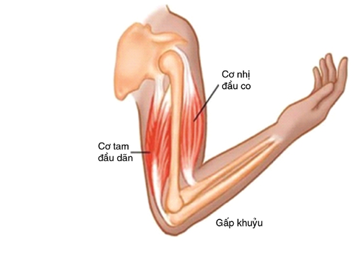 Điều trị đau và giới hạn duỗi khuỷu tay, cánh tay do bệnh lý  cơ tam đầu