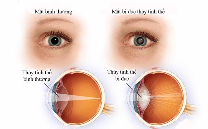 Các thuốc gia tăng nguy cơ đục thủy tinh thể