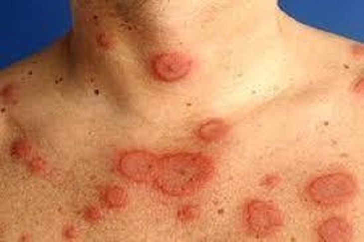 Ðể thoát khỏi vòng xoắn ngứa - gãi - ngứa của viêm da thần kinh