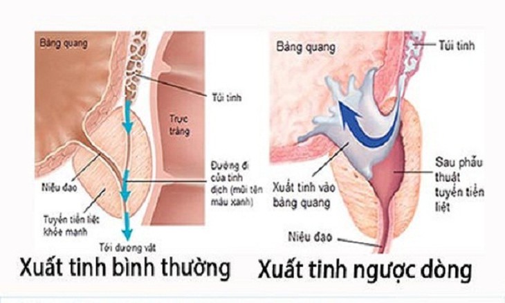 Các rối loạn xuất tinh làm ảnh hưởng tới khả năng sinh sản