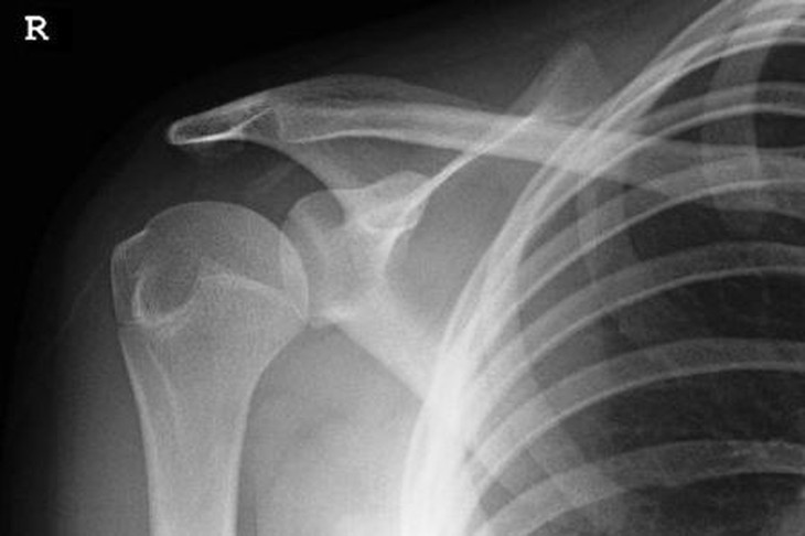 Những sai lầm khi xử trí bong gân, trật khớp