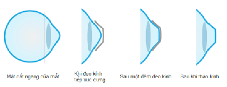 Loại kính tiếp xúc nào “trị” được tật khúc xạ?