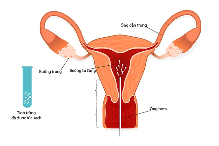 Thụ tinh nhân tạo và thụ tinh ống nghiệm