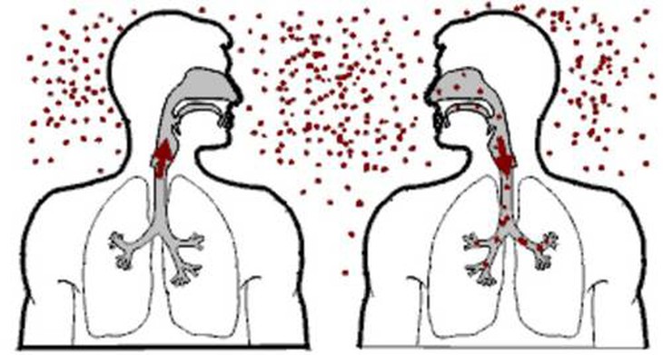 Bệnh lao kê và những nguy biến