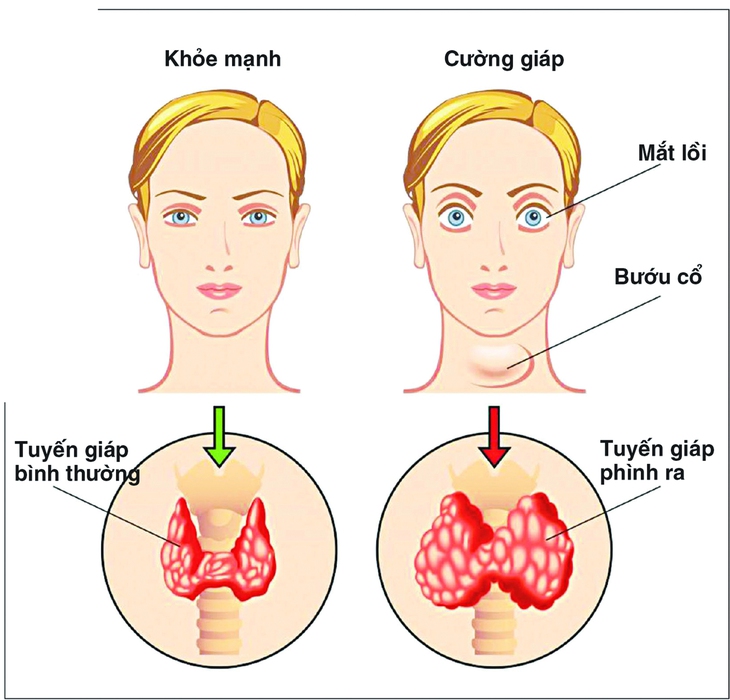 Iod  và các thuốc phòng chống suy giáp