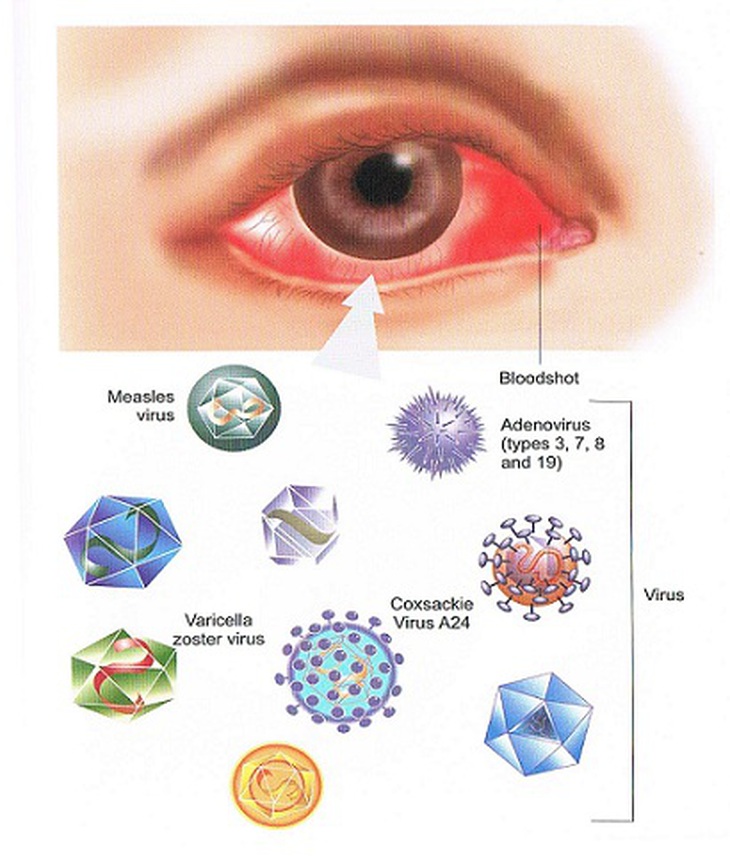 Đau mắt đỏ không thể coi thường