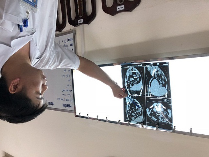 Hóc dị vật gây thủng ống tiêu hóa