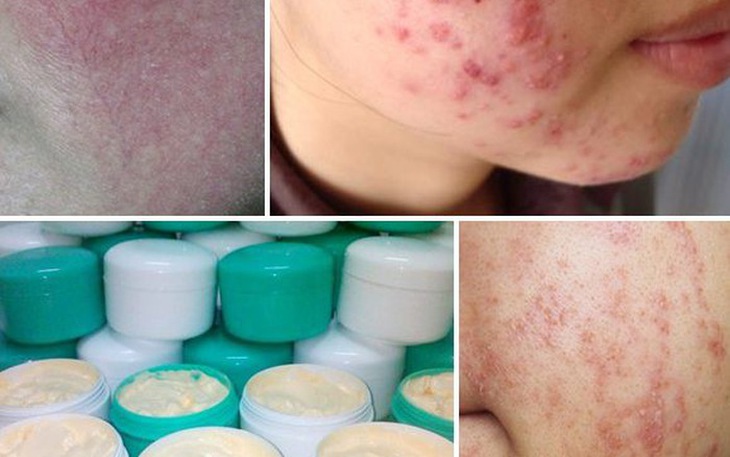 Trường hợp “hỏng da” vì kem trộn