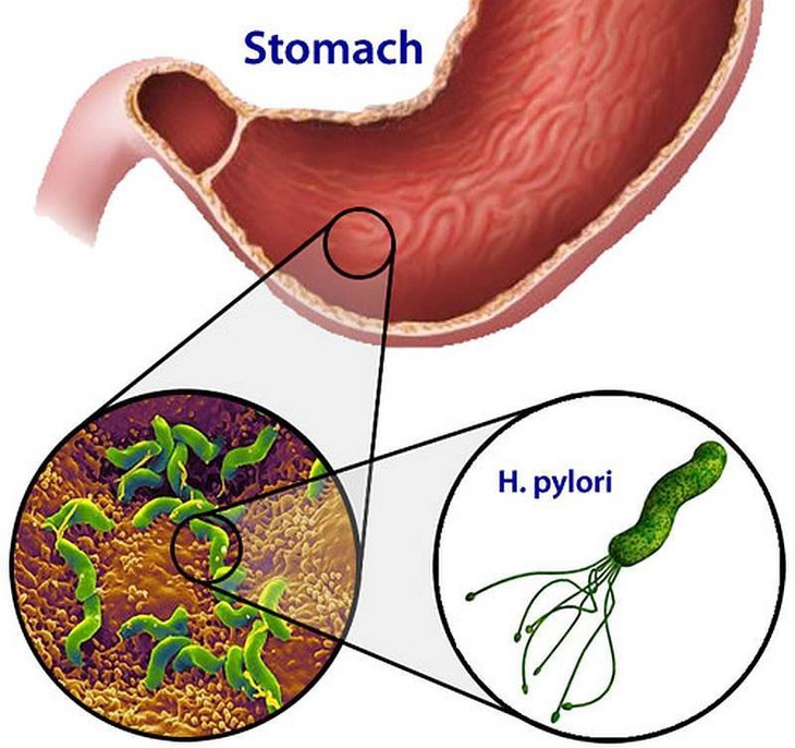 Chọn kháng sinh diệt vi khuẩn H.Pylori hiệu quả