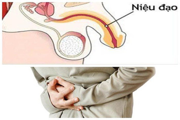 Bí tiểu ở trẻ