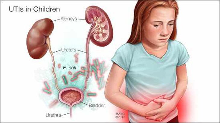 Viêm bàng quang ở trẻ em cần trị triệt để
