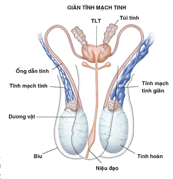 Giãn tĩnh mạch tinh