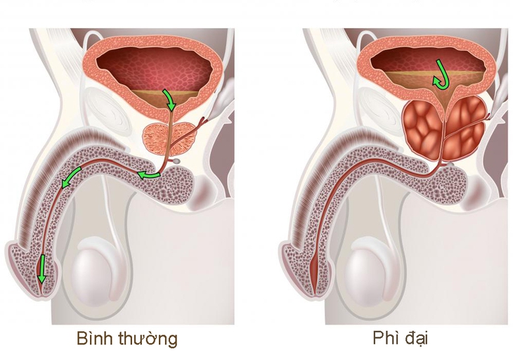 Phì đại lành tính tiền liệt tuyến
