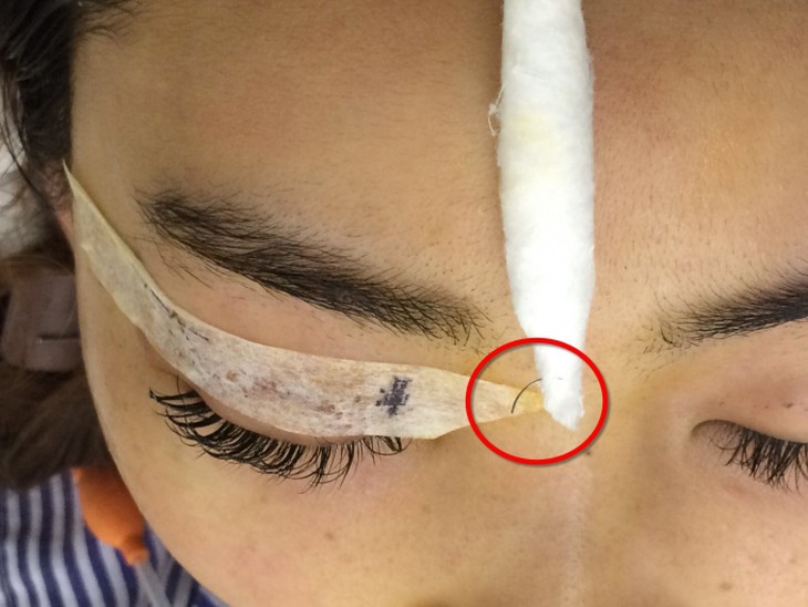 Lấy kim biến mất khi khâu nhấn mi chìm.