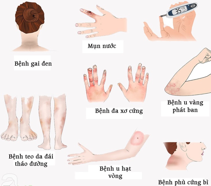 Làn da bị ảnh hưởng bởi đái tháo đường như thế nào?