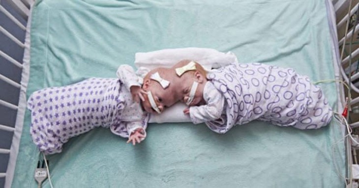 Chuyện ít biết về các cặp sinh đôi dính nhau