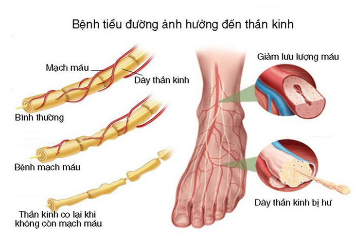 Cảnh giác với bệnh thần kinh ngoại biên