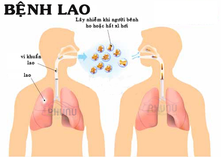 Nâng cao nhận thức về phòng, chống lao trong cộng đồng