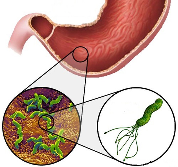 Dùng lansoprazol trị viêm loét dạ dày, cần lưu ý gì?