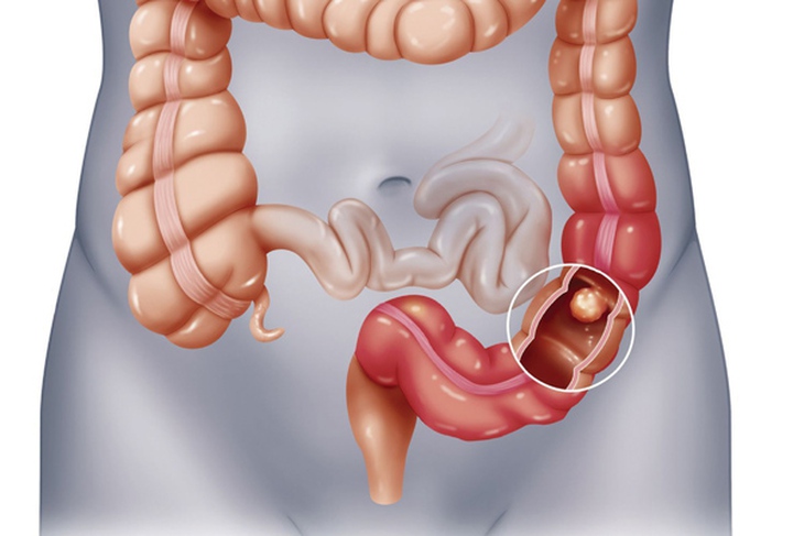 Tiêu chảy phân mỡ và nguy cơ với sức khỏe
