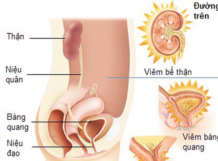 Ðẩy lùi viêm đường tiết niệu khi mang thai