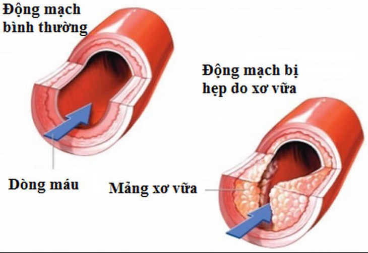 Rối loạn cương dương 