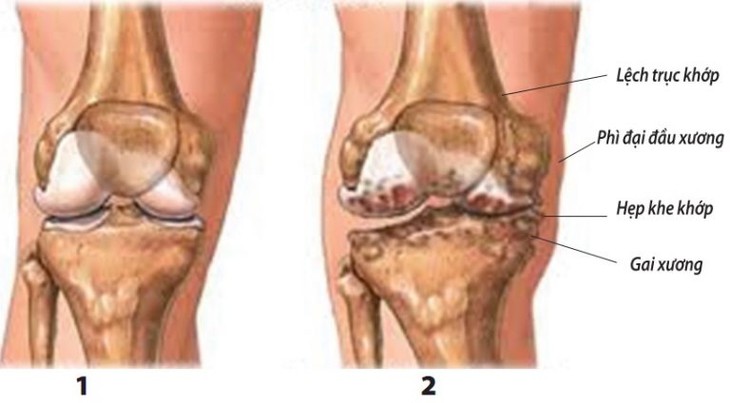 Cách kiểm soát thoái hóa khớp