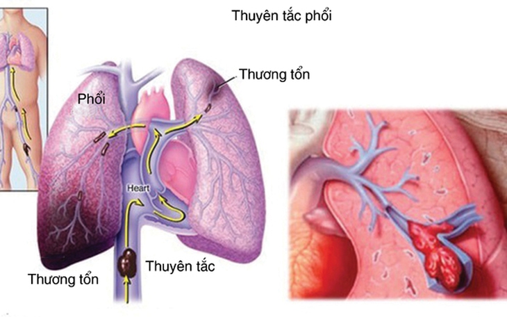 Cấp cứu “thuyên tắc phổi”: khẩn trương hơn cứu hỏa